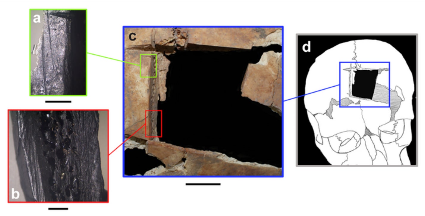 3,500-Year-Old Skull Reveals Evidence of Bronze Age Brain Surgery