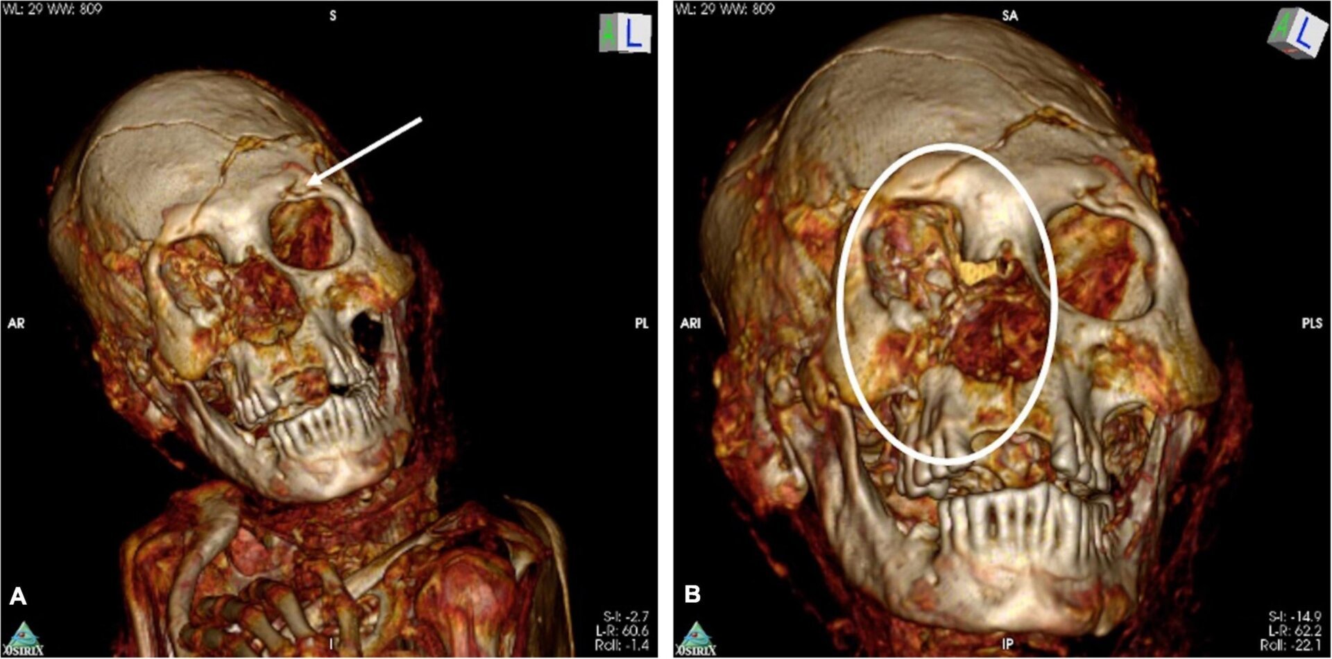 CT Scans Reveal Two 1,000-Year-Old South American Mummies Were Likely Murdered