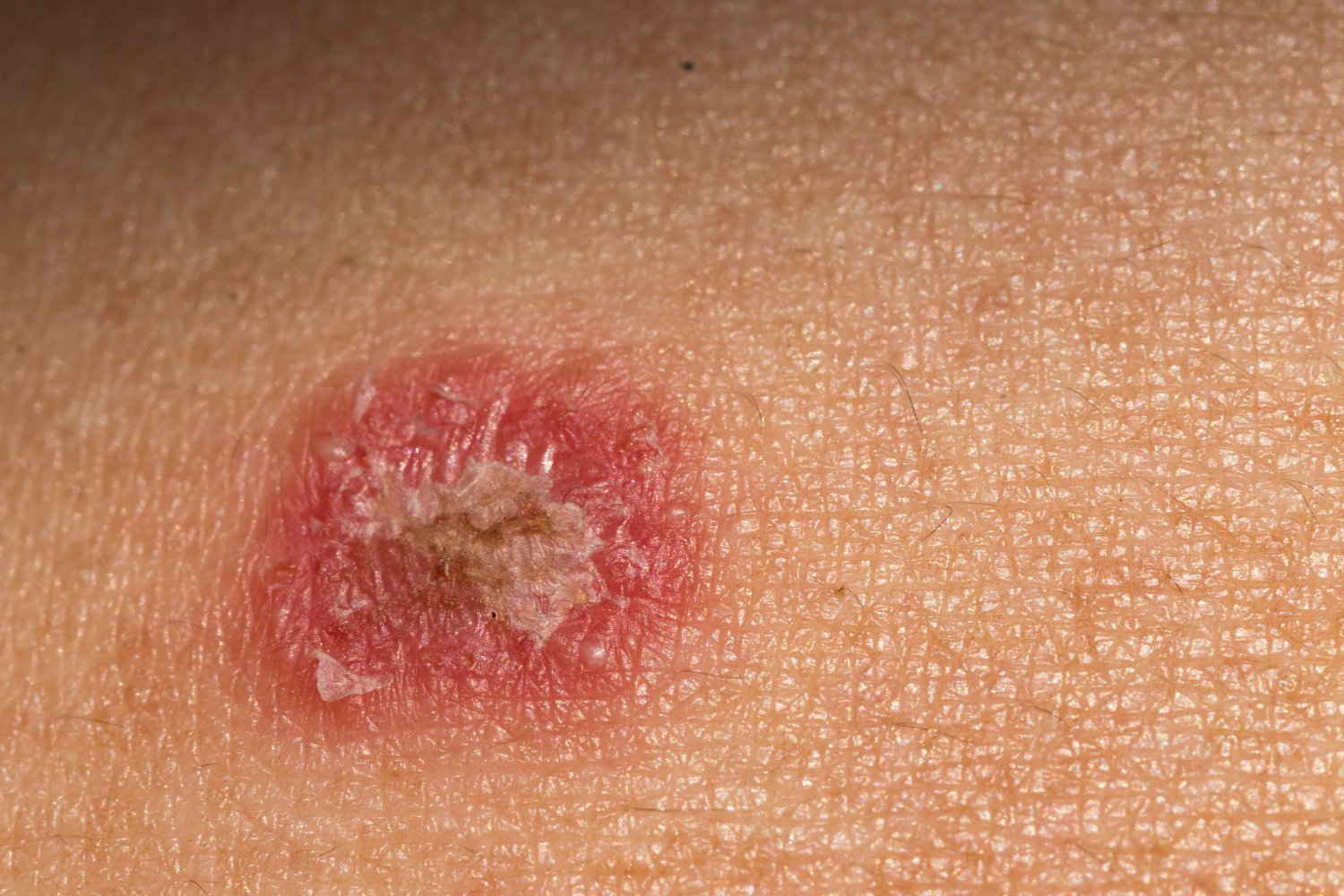 Sexually Transmitted Ringworm Fungus Emerges in New York City