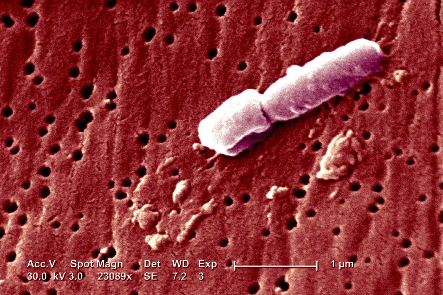 Hypervirulent Klebsiella pneumoniae: WHO Raises Concern Over Emerging Superbug