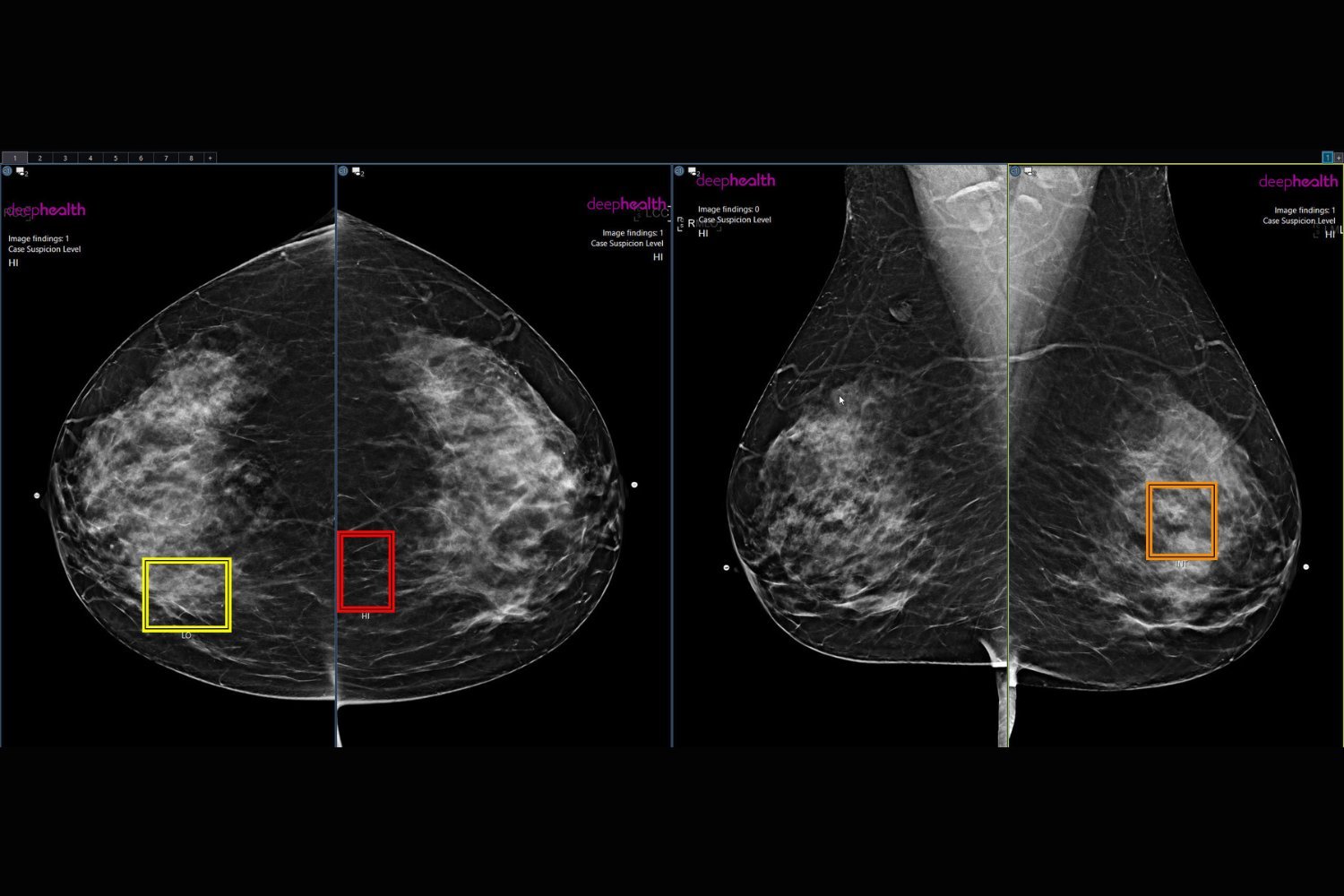 AI-Enhanced Mammograms Increase Cancer Detection Rates by 21%