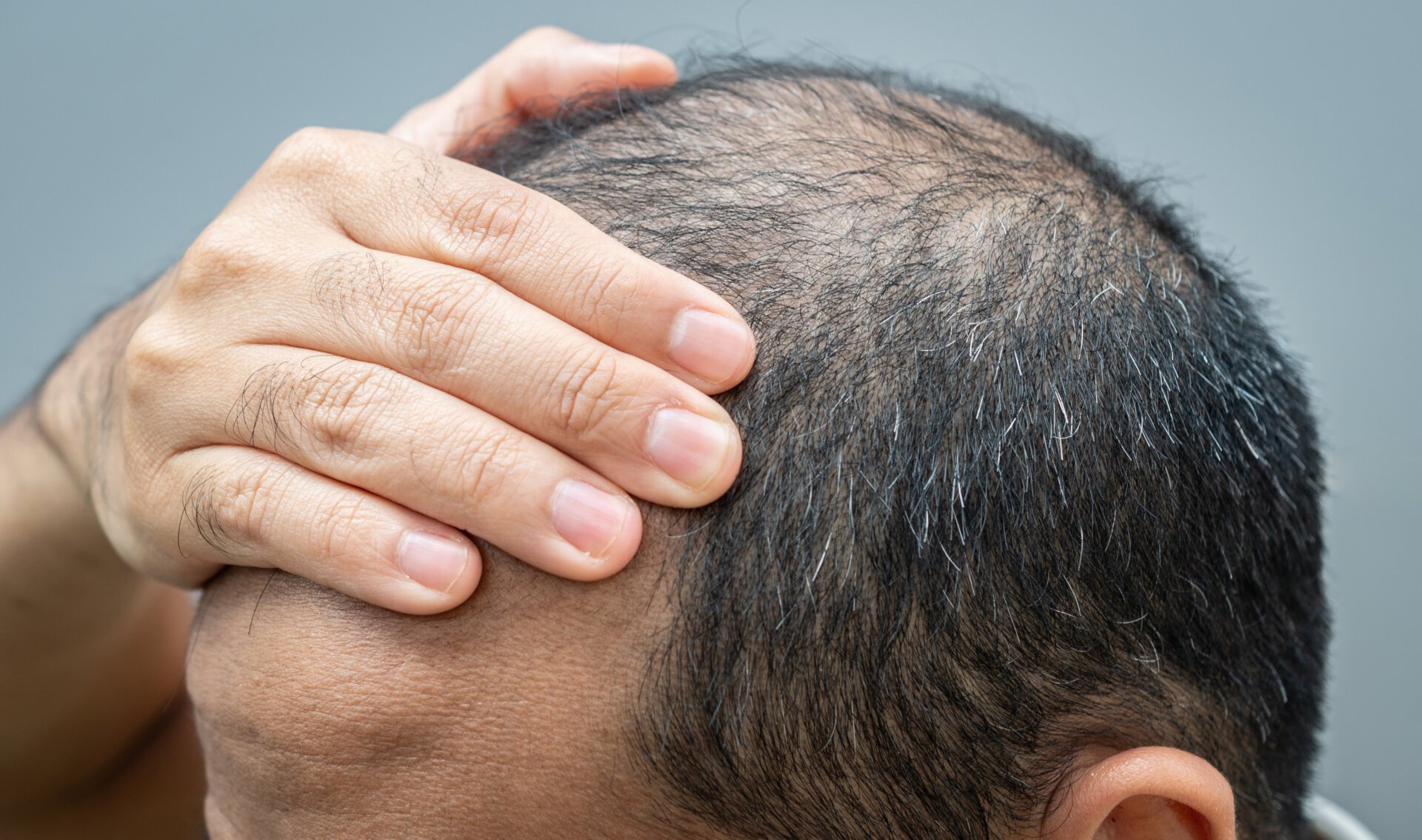 Oral Minoxidil: A Promising Alternative for Hair Loss Treatment