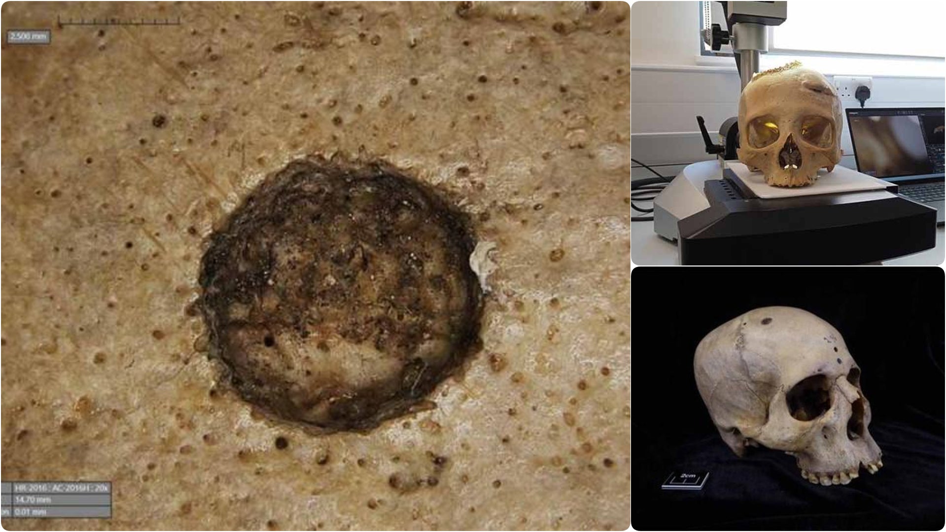 Earliest Evidence of Cancer Surgery Found in Ancient Egyptian Skulls