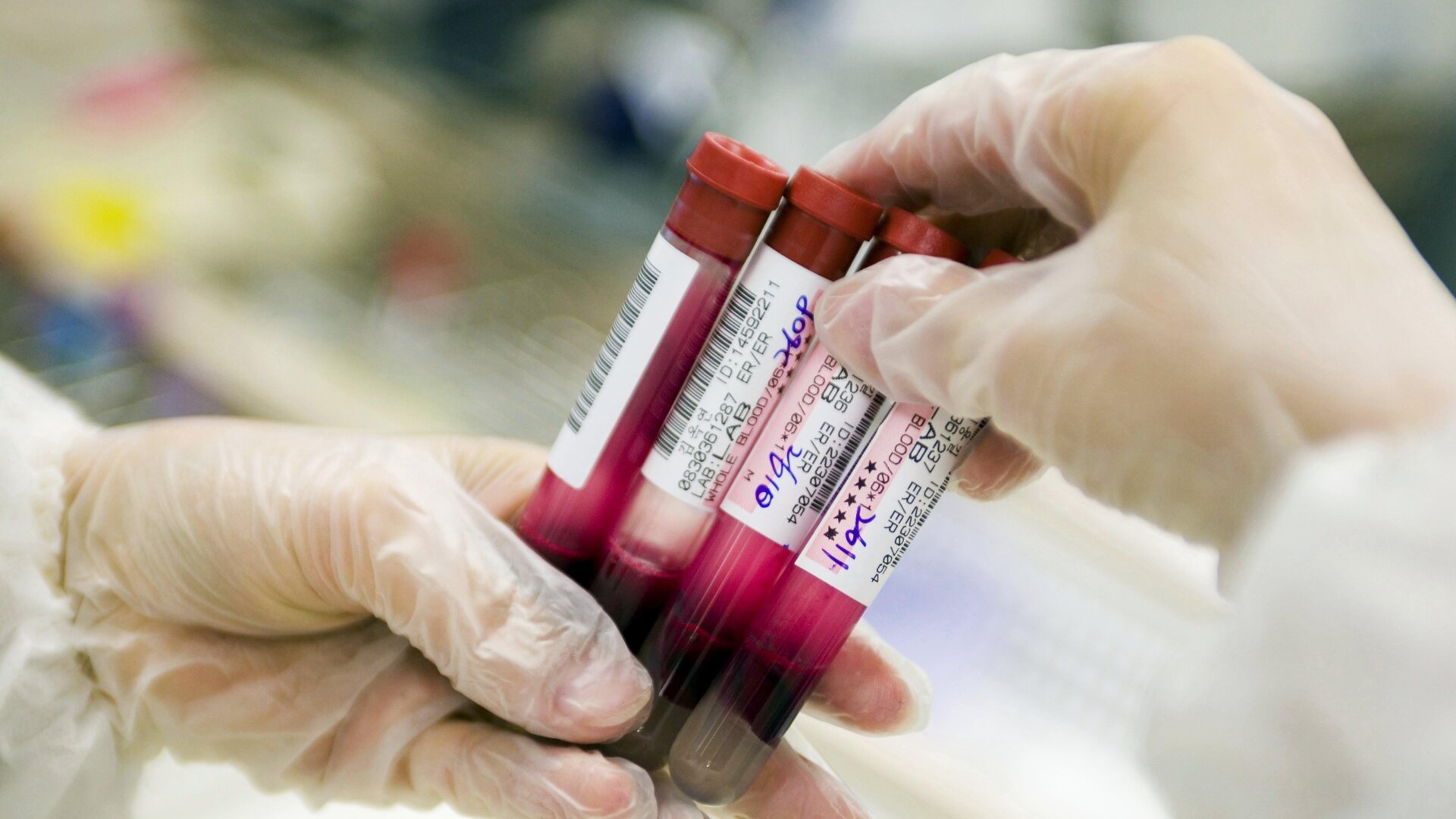 Promising New Blood Test Could Revolutionize Alzheimer's Diagnosis