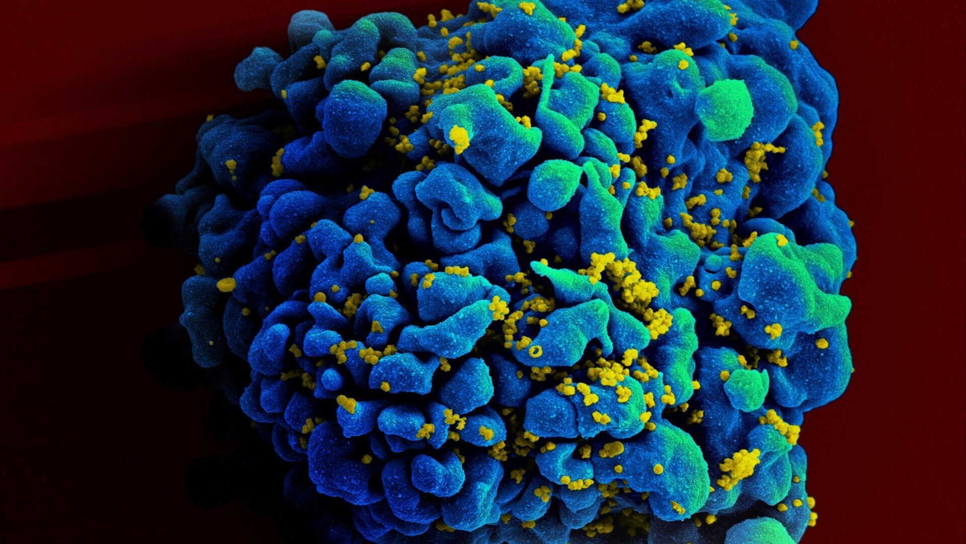 HIV Cure Achieved Without Genetically Modified Stem Cells