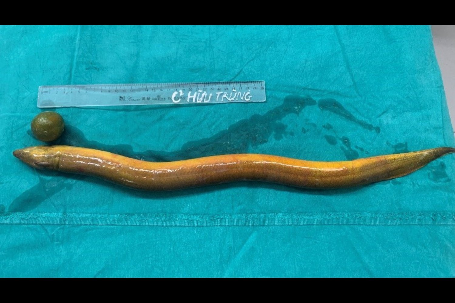 Man's Colon Partially Removed After Eel Chews Through Intestines