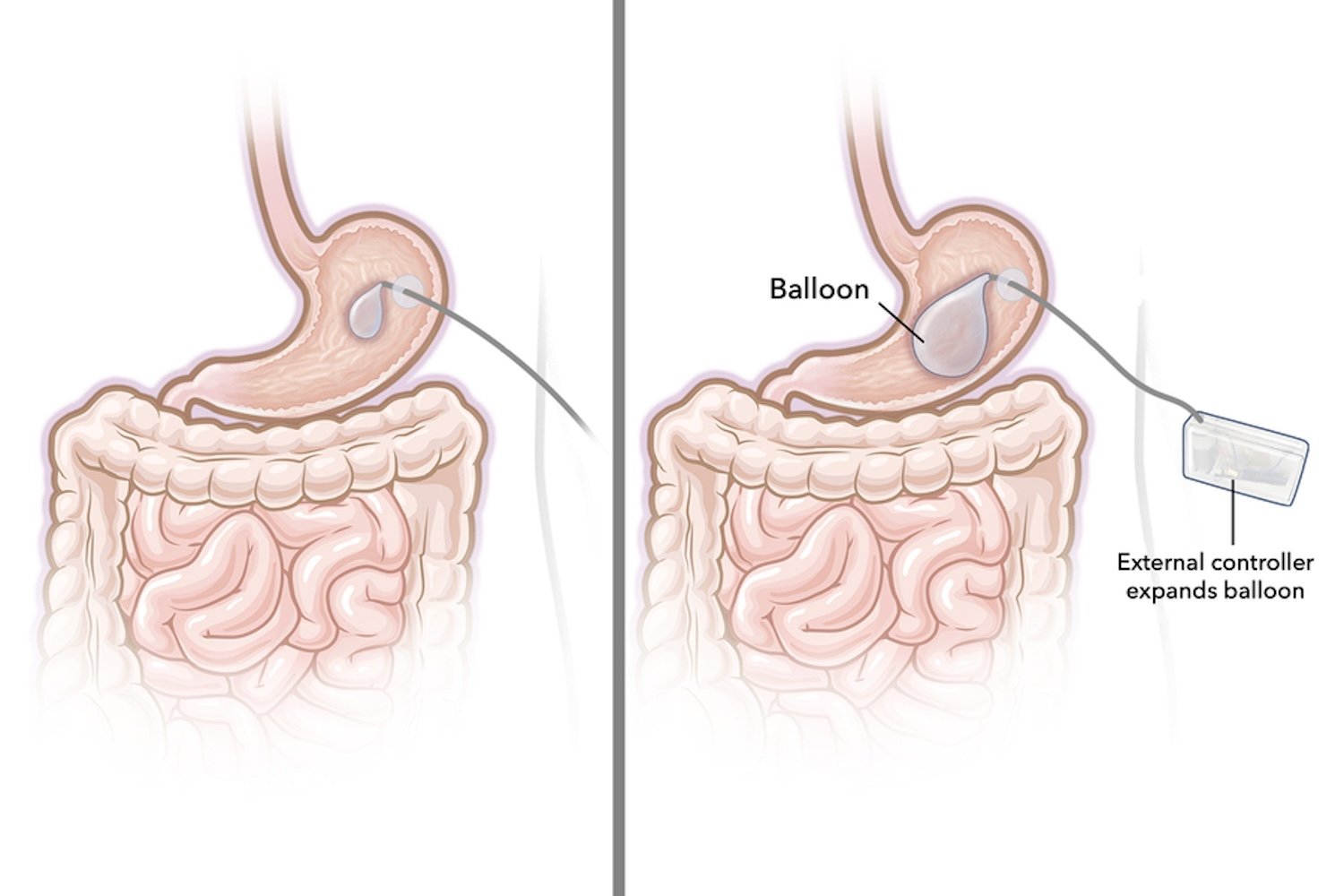 Dynamic Gastric Balloon Offers New Approach to Weight Loss