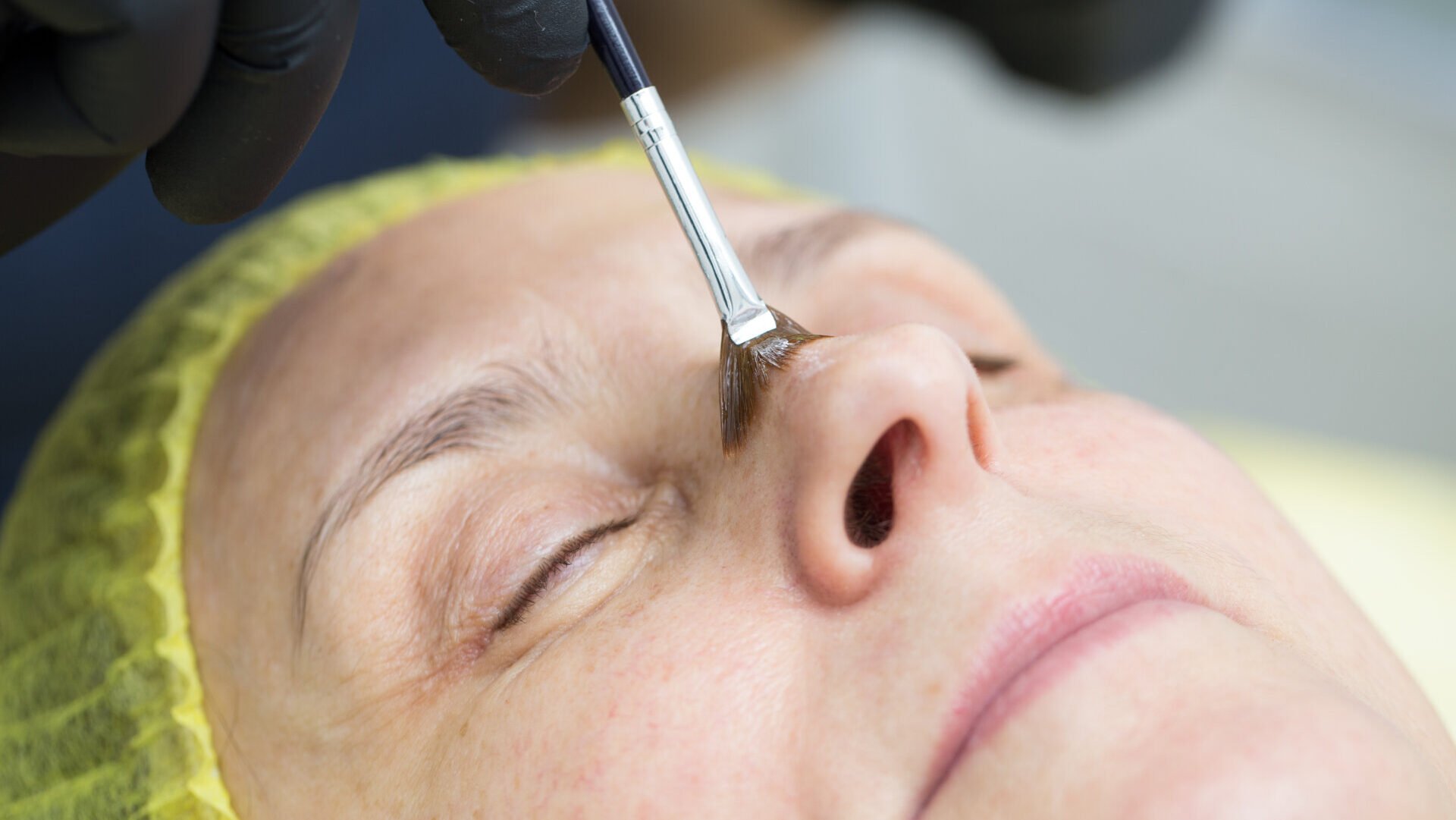 Dangers of At-Home Chemical Peels: FDA Issues Warning