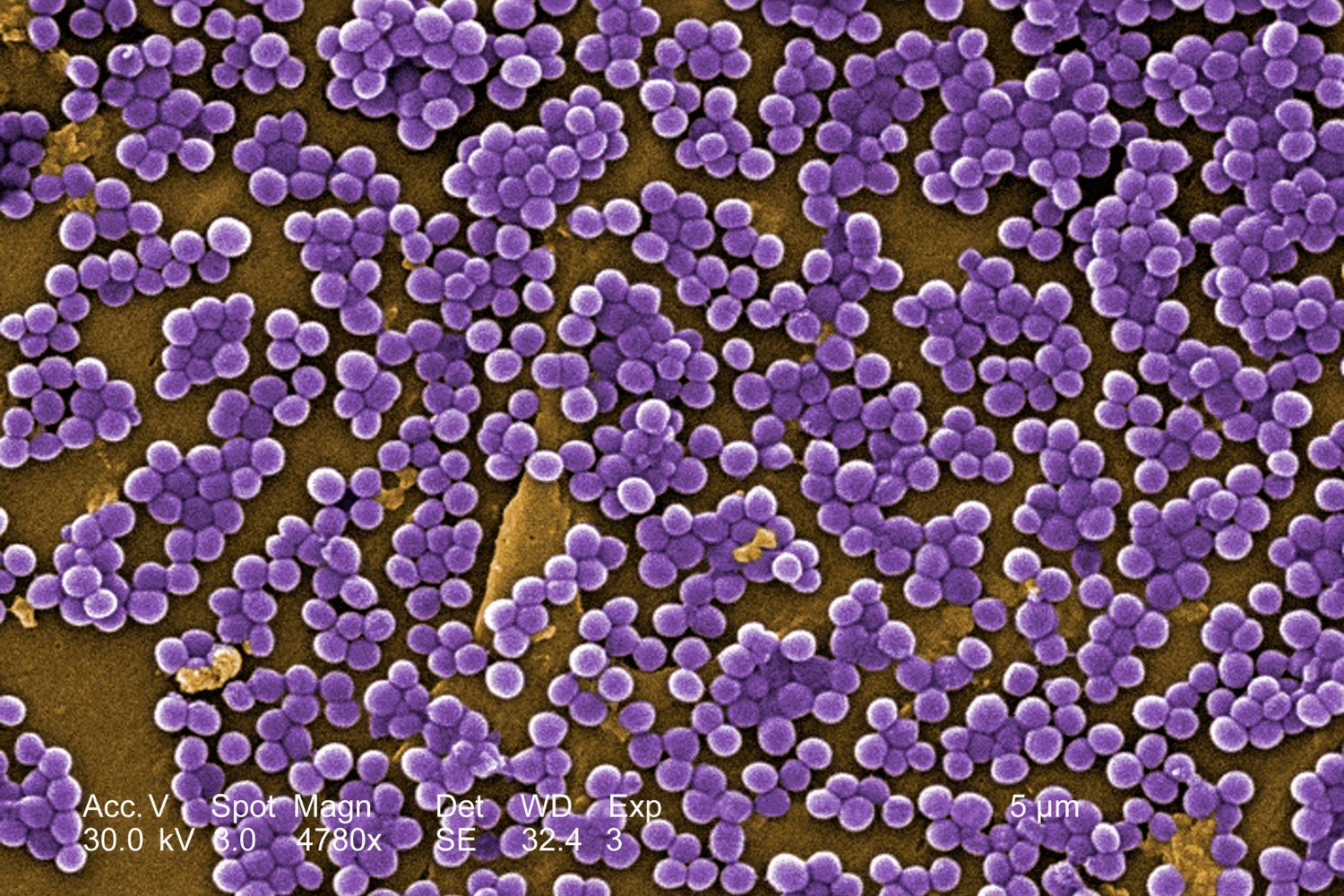 The Looming Threat of Drug-Resistant Bacteria: Millions of Lives at Stake