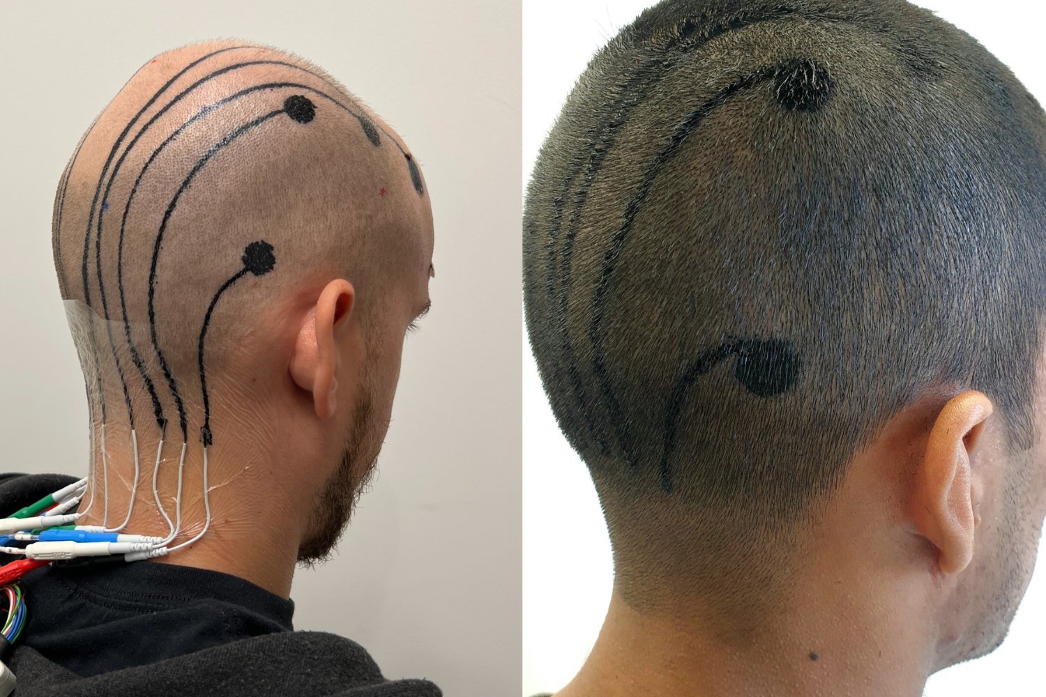 Revolutionizing Brain Monitoring: Temporary Electronic Tattoos for Enhanced Diagnostics