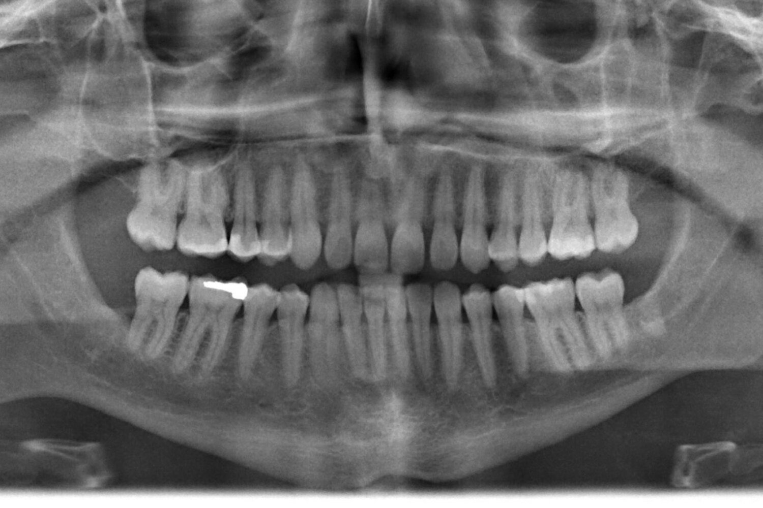 Rethinking Routine Dental X-Rays: Are They Always Necessary?