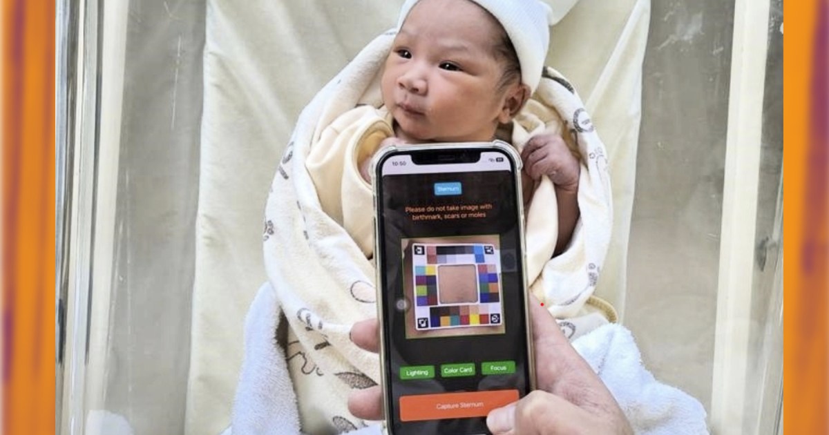 AI-Powered App Simplifies Infant Jaundice Screening for Parents