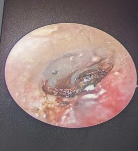 The woman’s tick-infested ear. © Shah et al/Journal of Medical Case Reports