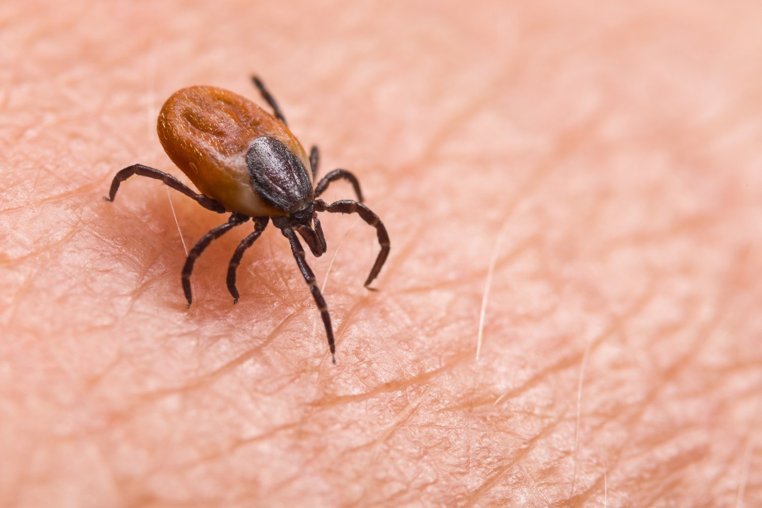 Kidney Transplant Leads to Rare Tick-Borne Illness