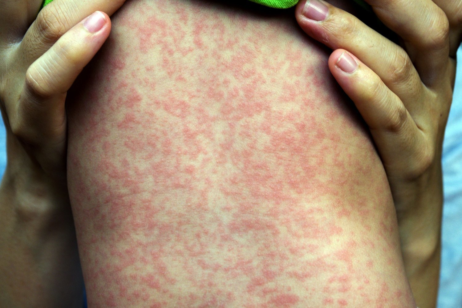 Measles Outbreak in Texas Highlights Vaccination Importance