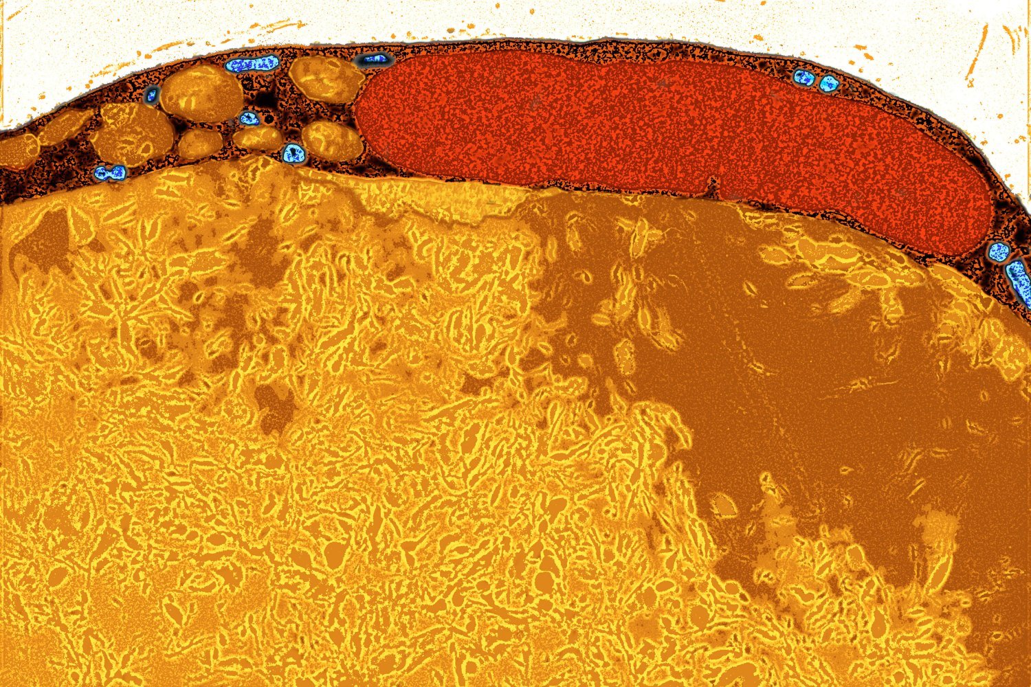 Engineered Fat Cells Show Promise in Starving Cancer Tumors