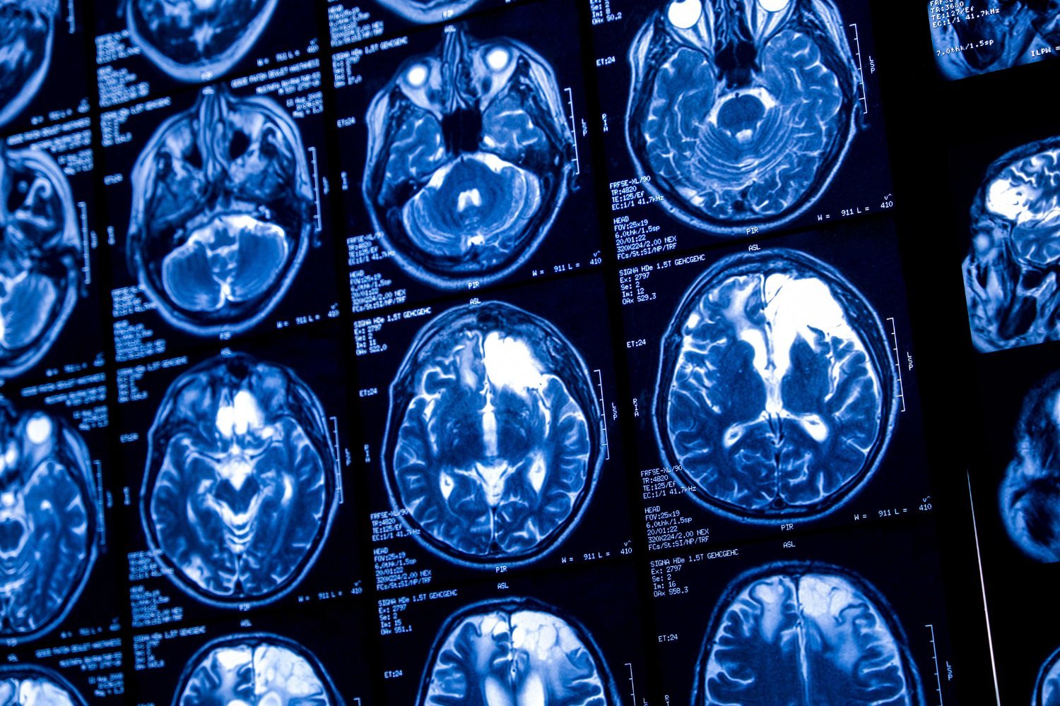 Creutzfeldt-Jakob Disease Cluster Investigated in Oregon County