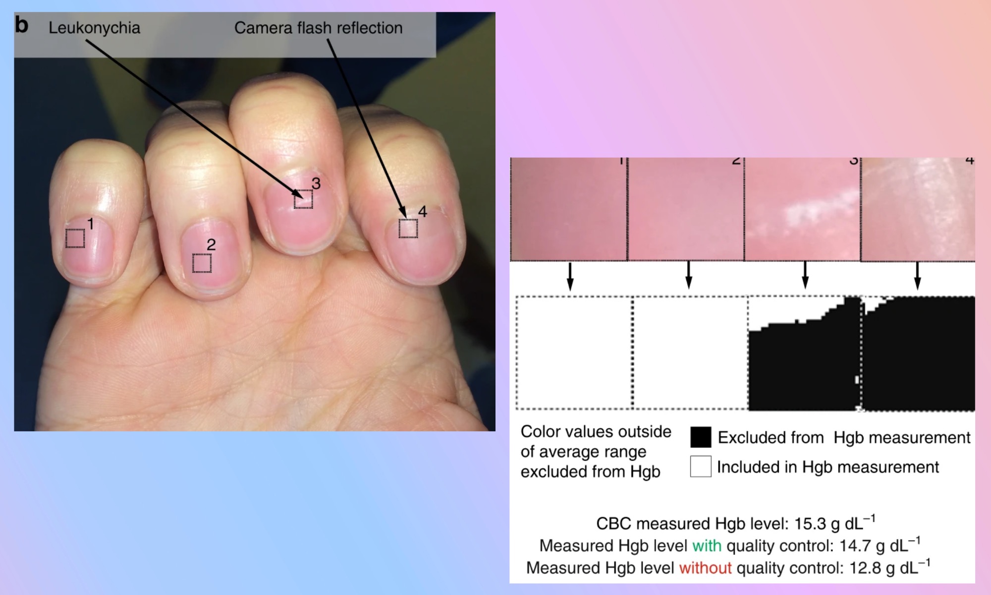Analysis of nail color by a mobile app.