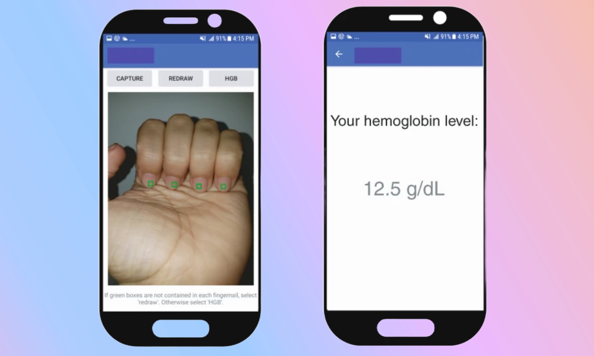 AI app assessing anemia risk on nail picture.