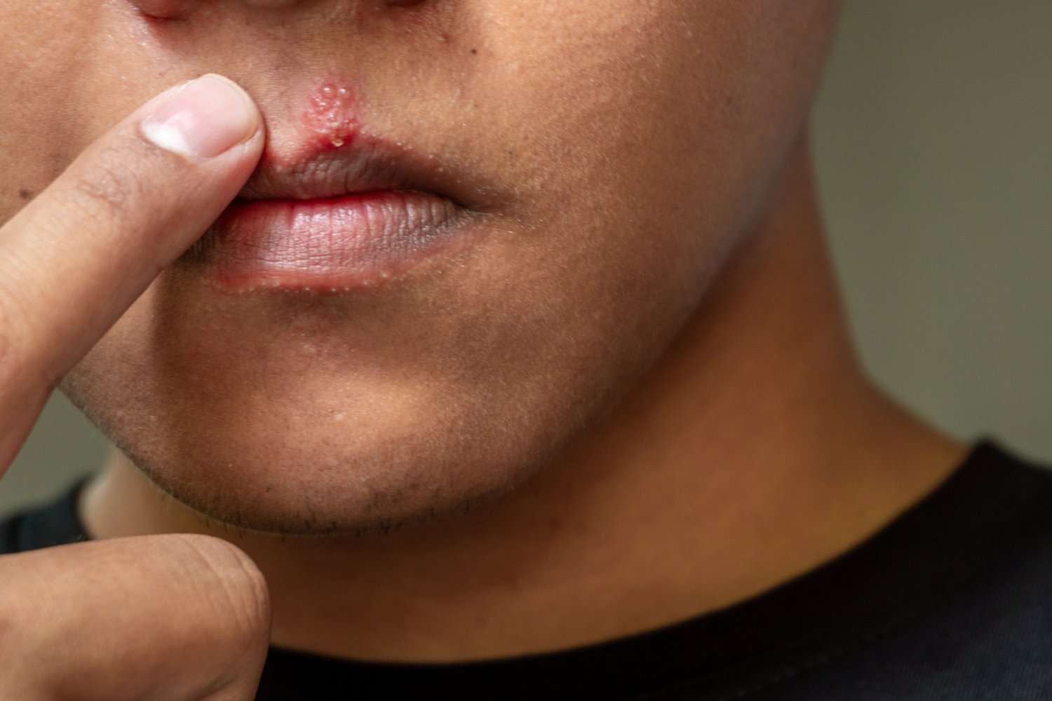 Herpes Viruses and Alzheimer's: Unpacking the Link
