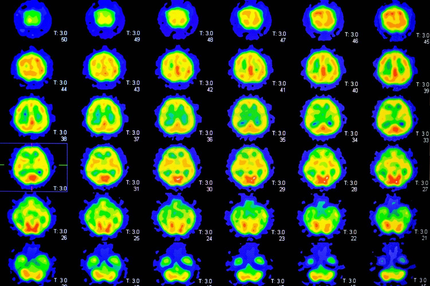 Knowing Your Alzheimer's Risk Doesn't Harm Mental Health, But May Impact Healthy Habits