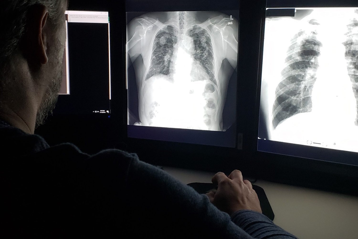 Lung Capacity Declines Earlier Than Previously Thought