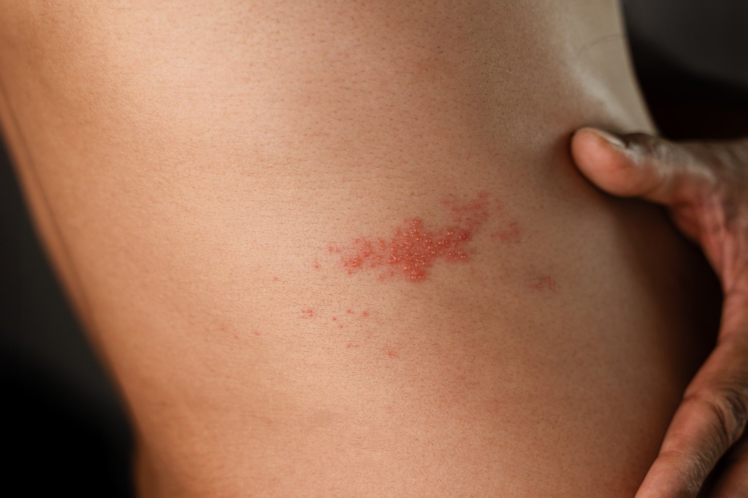 Shingles Vaccine Linked to Lower Heart Attack and Stroke Risk