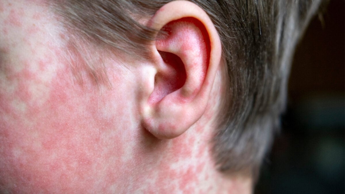Ontario Reports First Measles-Linked Infant Death This Year